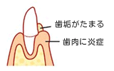 歯肉炎