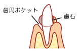 歯周炎その1