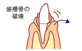 歯周炎その2