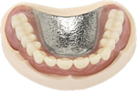 金属床義歯